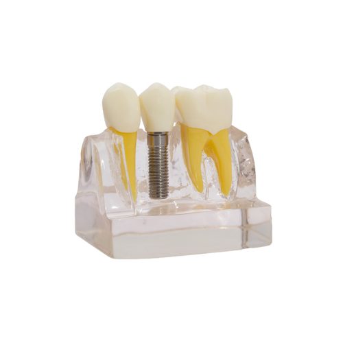 Modelo demostración de implantes Bader