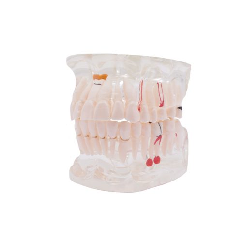 Modelo Transparente Bader con Implante